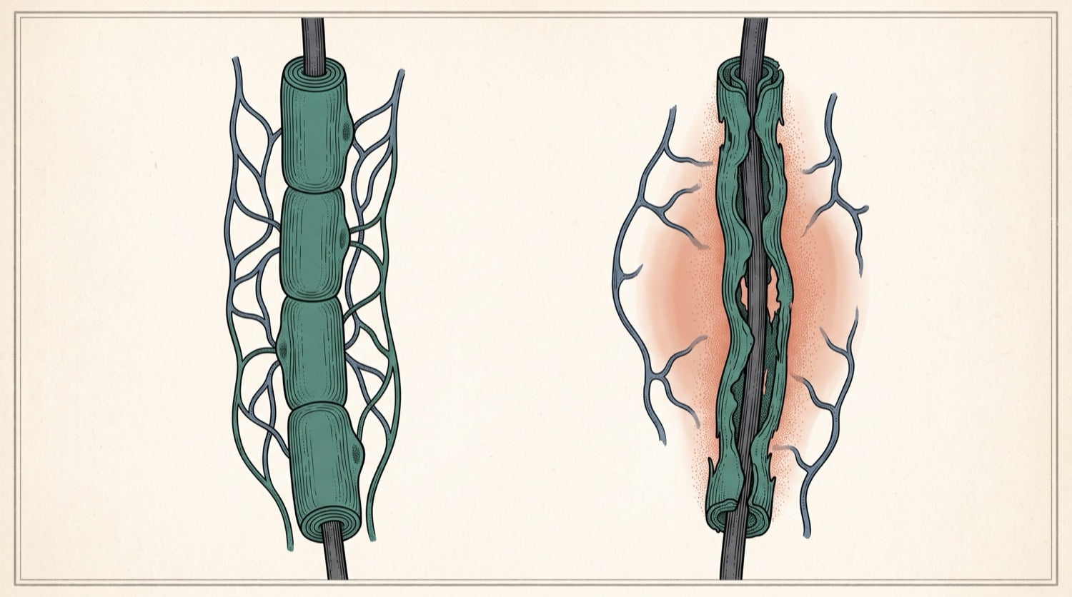 Two peripheral nerve fibres side by side: one with an even sheath and full vessels, one thinned and frayed.